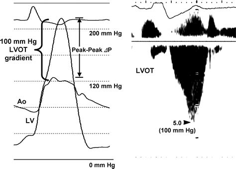 normal lv outflow gradient